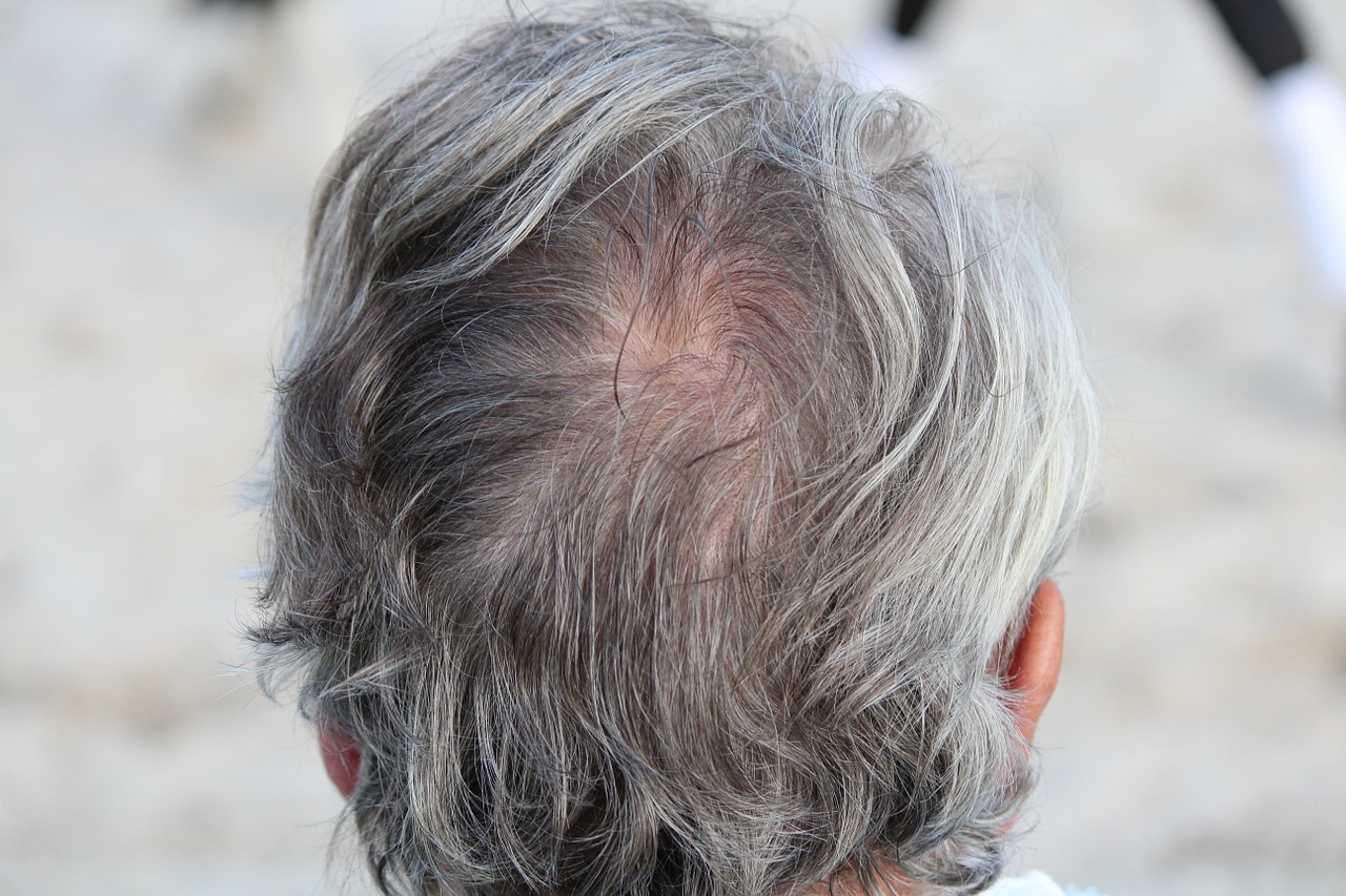 hair loss treatment